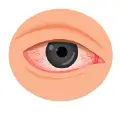 dry_eyes